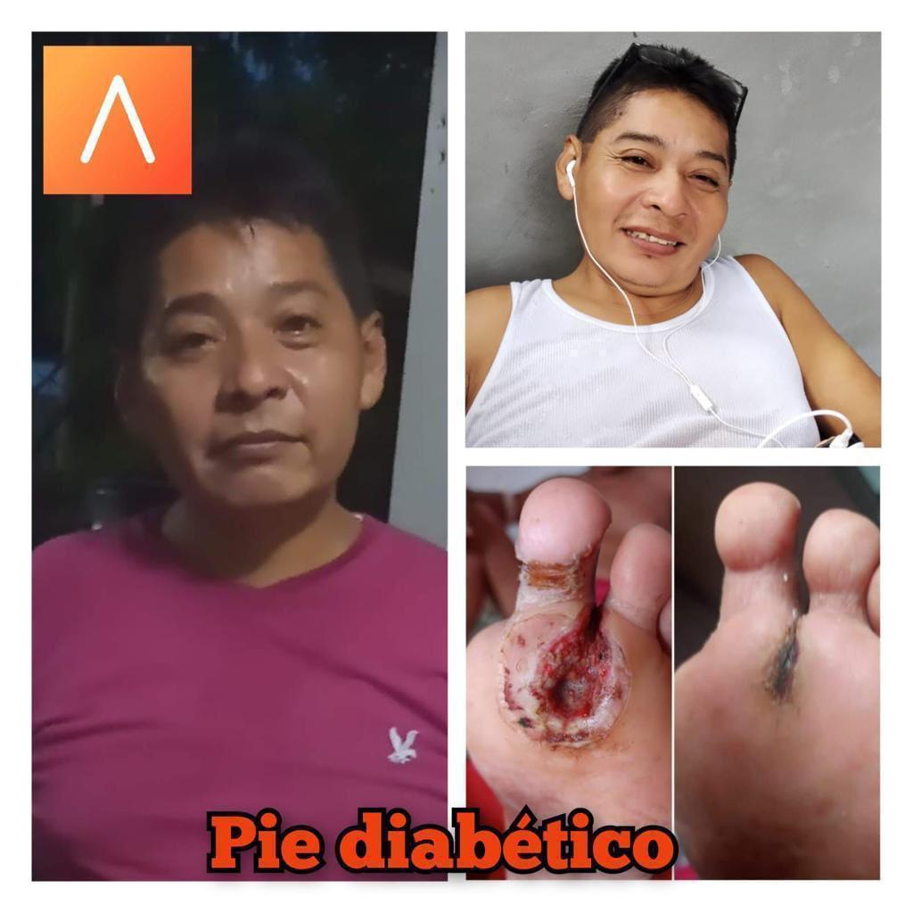 Antes: lesión en pie por diabetes de mi papá