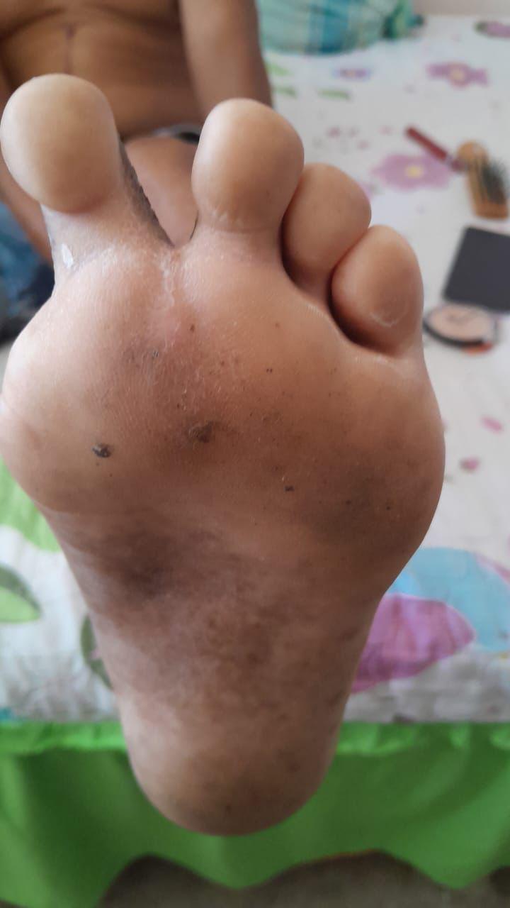 Después: recuperación visible del pie de mi papá